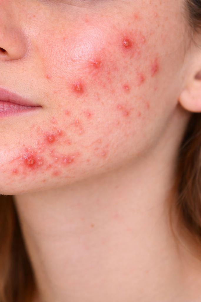 Wangenpartie mit sichtbaren Entzündungen, Pickeln und Pusteln