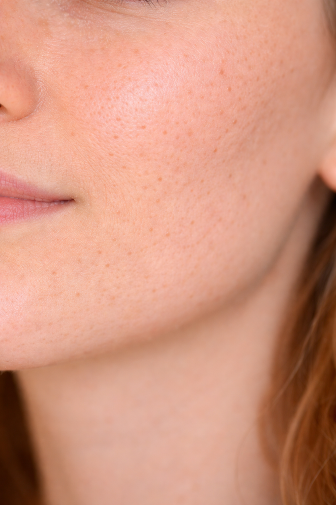 Wangenpartie einer verstopften Haut. Sichtbar vergrößerte Poren und Unreinheiten.