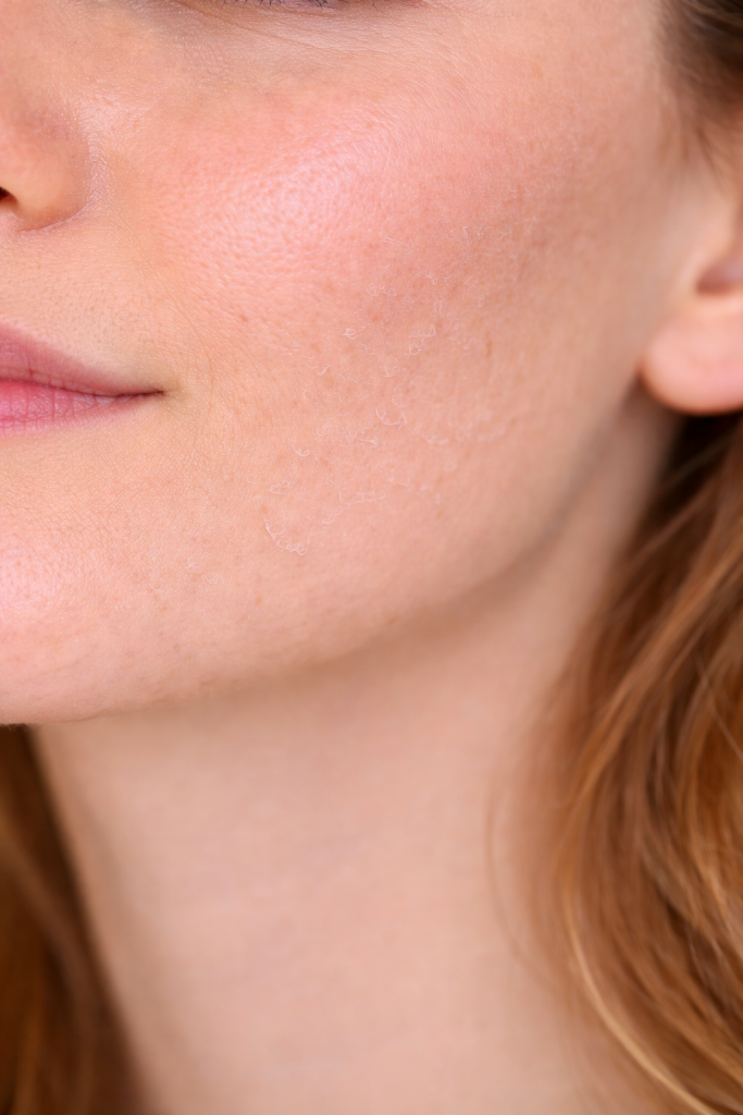 Wangenpartie instbabiler Hautbarriere. Haut ist unebenmäßig und trocken. 