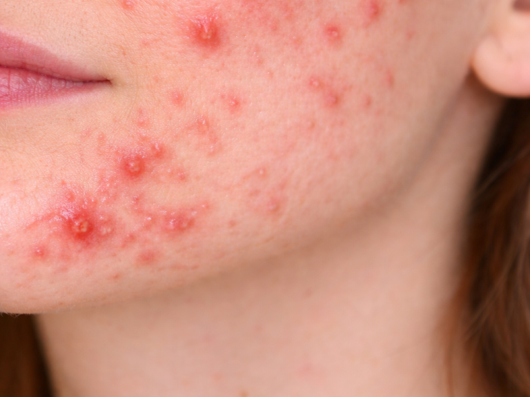 Haut mit roten Akne-Pickeln und Unreinheiten im Kinnbereich.