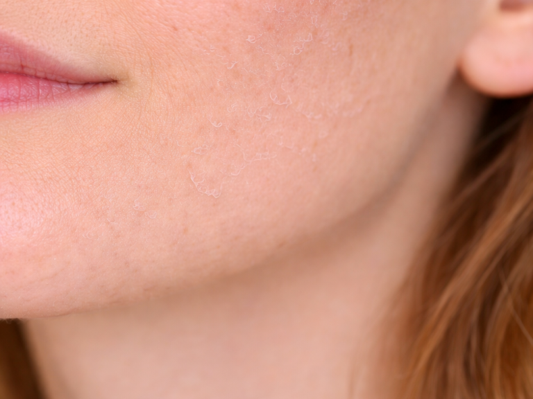 Nahaufnahme einer Kinnpartie mit geschwächter Hautbarriere. Sichtbar trockene Haut die sich leicht schuppt. Das Hautbild wirkt unebenmäßig.