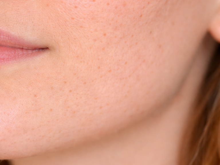 Nahaufnahme einer Gesichtsseite mit verstopfter Haut und sichtbaren Mitessern und vergrößerten Poren.