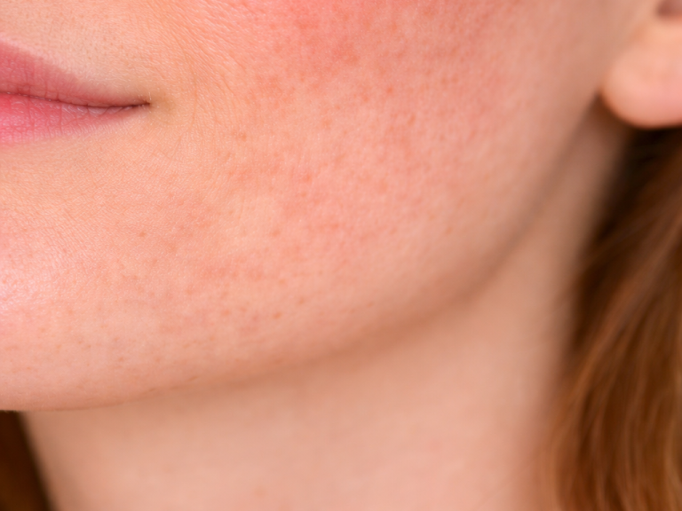 Nahaufnahme einer Wange mit sichtbar roter Haut. Die Haut wirkt trocken und ebenmäßig.