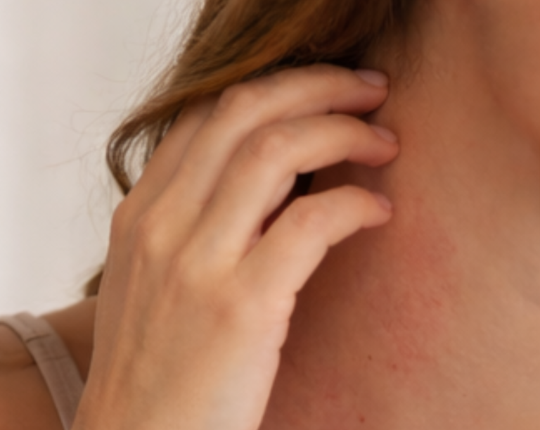 Eine Hand berührt sanft den Halsbereich mit geröteter Haut.